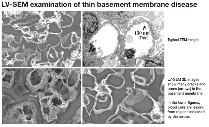 Fig. 6　LV-SEM images of glomeruli in thin basement membrane disease