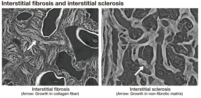 Fig. 9　Distinguishing interstitial sclerosis from interstitial fibrosis