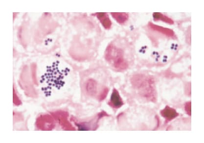 Fig. 3　Detection of gram-positive cocci with Gram staining